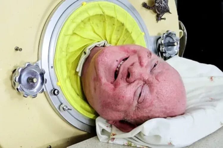 États-Unis : Après une lutte de 72 ans contre la polio, Paul Alexander, qui vivait dans un “poumon de fer”, nous a quittés.